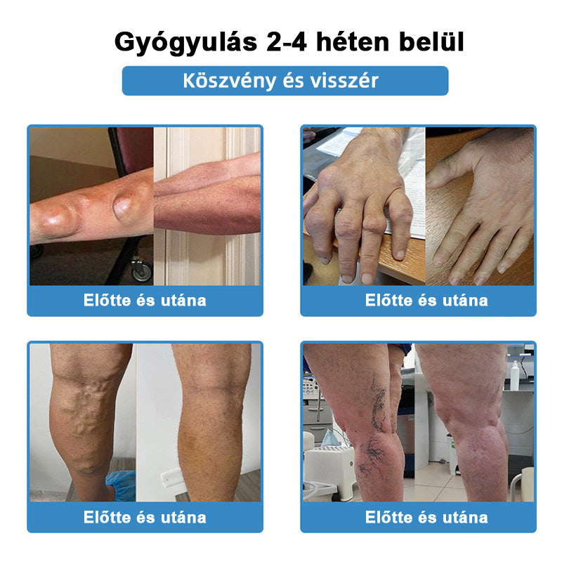 Hivatalos áruház：🌱𝐇𝐞𝐚𝐥𝐫𝐢𝐳𝐞® Nano-bevezető ízületi terápia (fájdalommentes, tartós, ízületi gyulladás, visszér és különböző ortopédiai betegségek esetén alkalmazható)