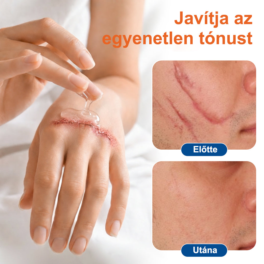 Trilumia® DermalRebuild bőrfiatalító gél👨‍⚕️Keloid hegek, akne hegek, bárányhimlő hegek, műtéti hegek, égési hegek