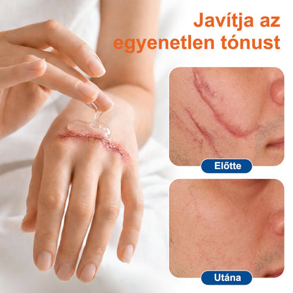 Trilumia® DermalRebuild bőrfiatalító gél👨‍⚕️Keloid hegek, akne hegek, bárányhimlő hegek, műtéti hegek, égési hegek