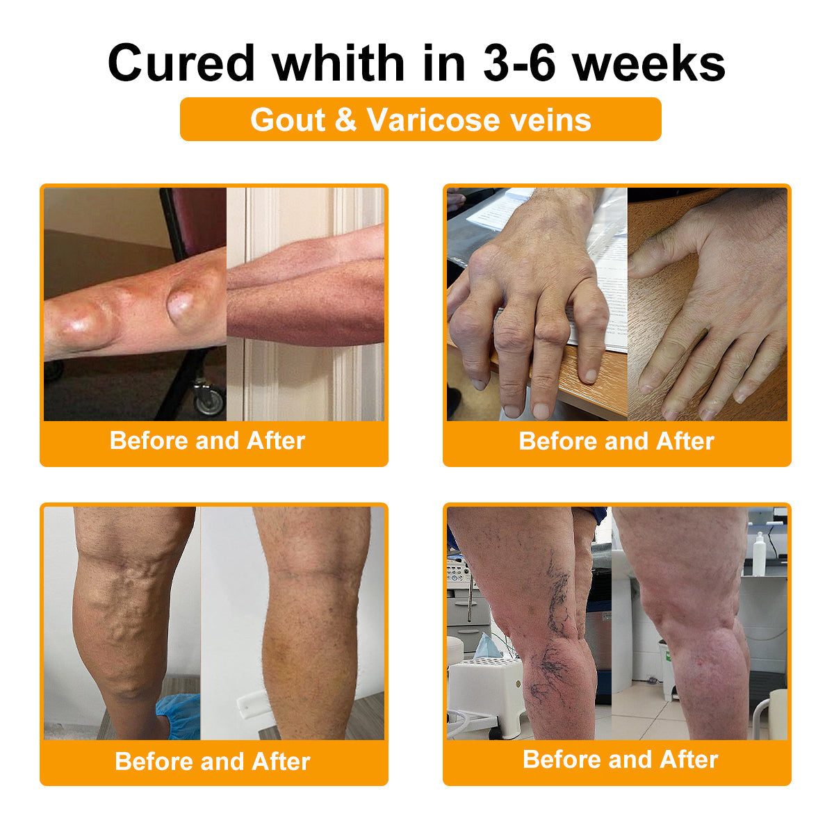 ✅TLOPA® Fájdalomcsillapító, 😊csontregeneráló krém botulinum-toxinnal és méhméreggel 🐝