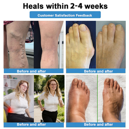 Healrize® 🗽4-in-1 Vein & Joint Nano Microneedle Advanced Therapy Patch🔥Instant Relief, Long-Term Results