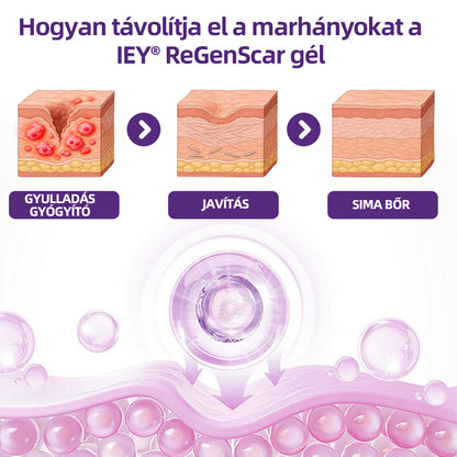 IEY® ReGenScar őssejt-heggyel kezel👨‍⚕️Keloid hegek, akne hegek, bárányhimlő hegek, műtéti hegek, égési hegek