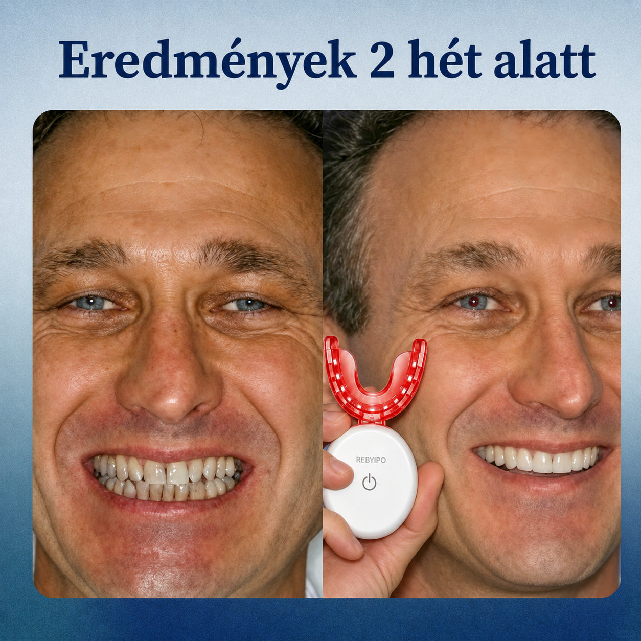🔥 Spórolj 50%-ot Ma! 丨 REBYIPO® GumRevive – Fejlett Kettős Hullámhosszú Ínyápoló Rendszer 🦷✨