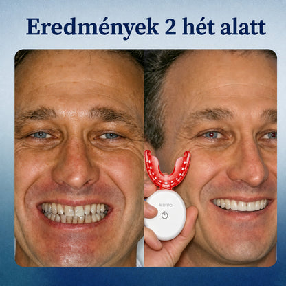 🔥 Spórolj 50%-ot Ma! 丨 REBYIPO® GumRevive – Fejlett Kettős Hullámhosszú Ínyápoló Rendszer 🦷✨