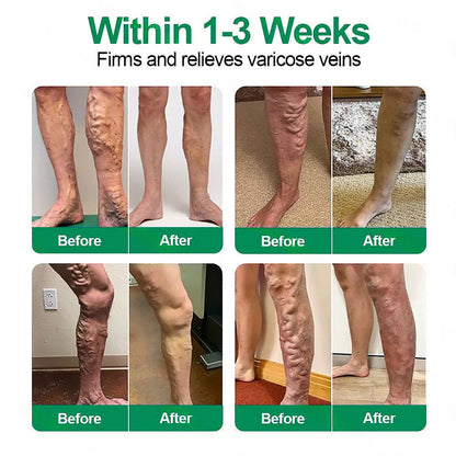 Healrize® 🛒VeinTarget mikrotűs tapasz ⚡Azonnali enyhülés hosszú távú eredmények