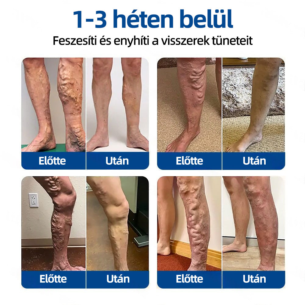 🇭🇺𝐇𝐞𝐚𝐥𝐫𝐢𝐳𝐞® ✅VeinTarget mikrotűs tapasz👩‍⚕️⚡Azonnali enyhülés hosszú távú eredmények