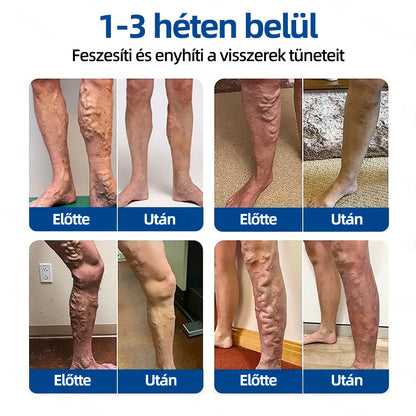 🇭🇺𝐇𝐞𝐚𝐥𝐫𝐢𝐳𝐞® ✅VeinTarget mikrotűs tapasz👩‍⚕️⚡Azonnali enyhülés hosszú távú eredmények