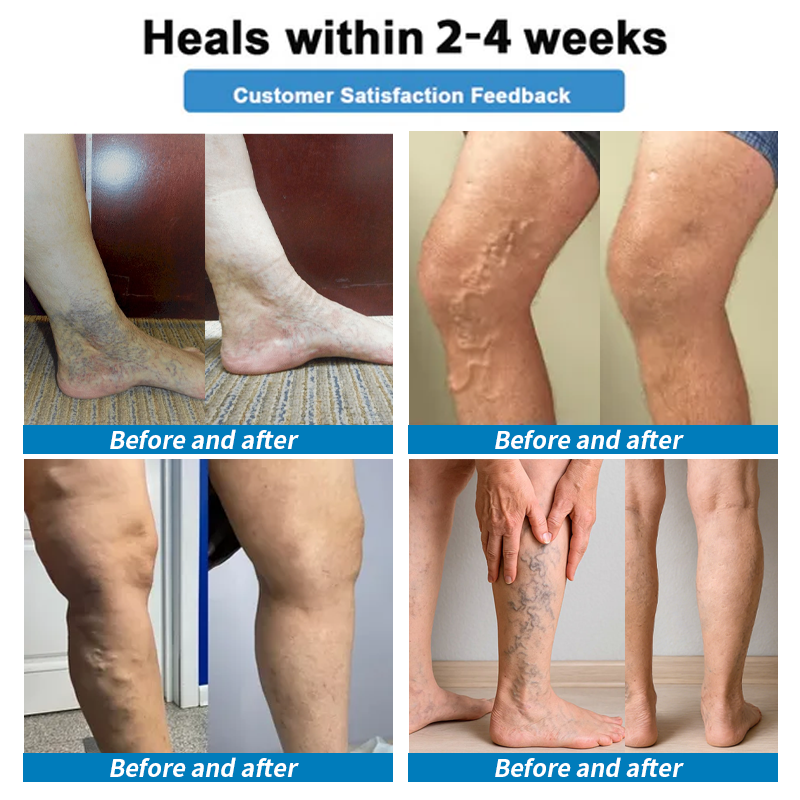 Healrize® 🗽4-in-1 Vein & Joint Nano Microneedle Advanced Therapy Patch🔥Instant Relief, Long-Term Results