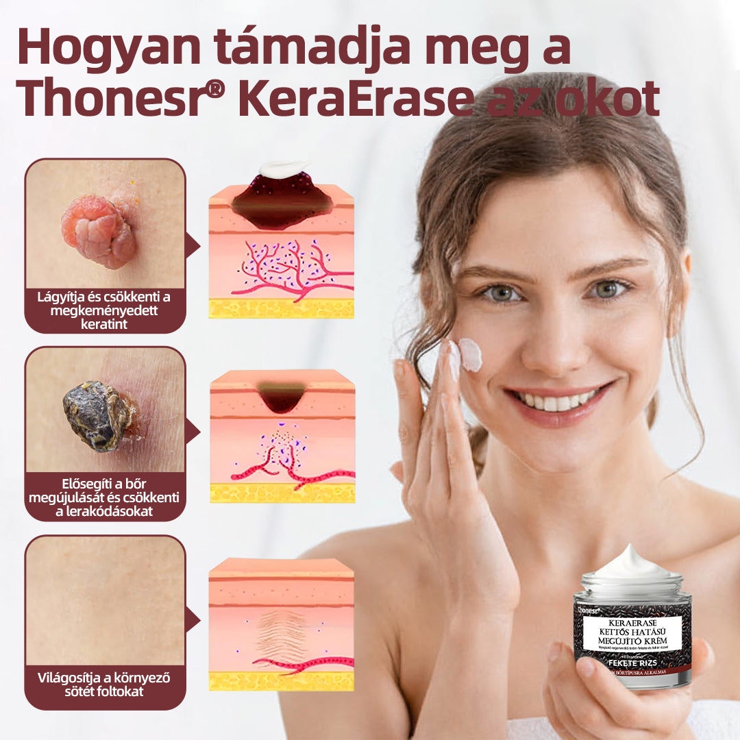 Thonesr® 👩‍⚕️KeraErase kettős hatású megújító krém