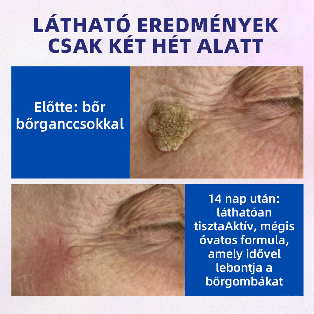 🏆 Magyarország legkelendőbb terméke | 🛡️ 48 órás fájdalommentes bőrtisztítás DOCTIA® szilárd szivacsos szemölcseltávolító