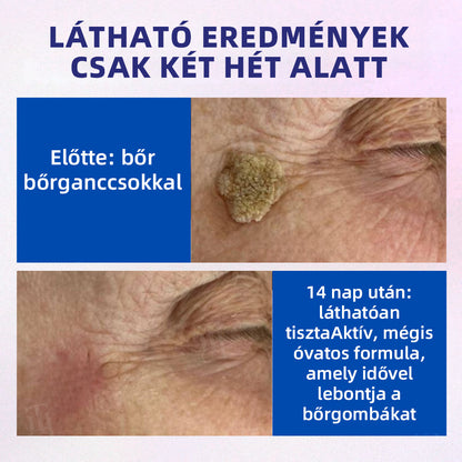 🏆 Magyarország legkelendőbb terméke | 🛡️ 48 órás fájdalommentes bőrtisztítás DOCTIA® szilárd szivacsos szemölcseltávolító
