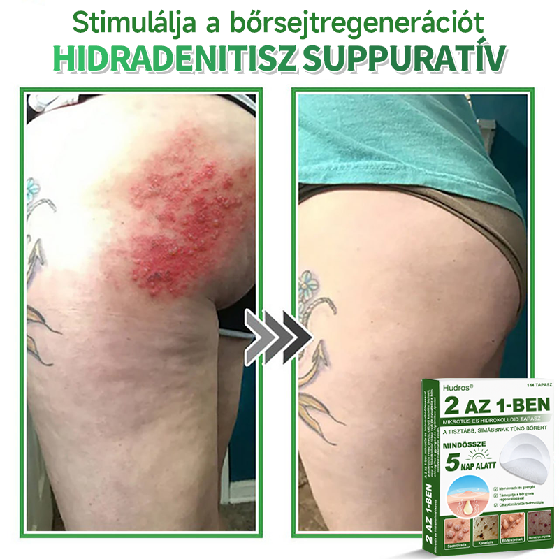 📌 𝐇𝐮𝐝𝐫𝐨𝐬® 𝟐 𝐚𝐳 𝟏-𝐛𝐞𝐧 𝐦𝐢𝐤𝐫𝐨𝐭ű𝐬 𝐡𝐢𝐝𝐫𝐨𝐤𝐨𝐥𝐥𝐨𝐢𝐝 𝐭𝐚𝐩𝐚𝐬𝐳𝐨𝐤 | 𝐊𝐢𝐞𝐦𝐞𝐥𝐤𝐞𝐝ő 𝐚𝐧𝐲𝐚𝐣𝐞𝐠𝐲𝐞𝐤, 𝐩𝐚𝐭𝐭𝐚𝐧á𝐬𝐨𝐤, 𝐥𝐚𝐩𝐨𝐬 𝐬𝐳𝐞𝐦ö𝐥𝐜𝐬ö𝐤 é𝐬 𝐛ő𝐫𝐤𝐢𝐧ö𝐯é𝐬𝐞𝐤 𝐞𝐥𝐭á𝐯𝐨𝐥í𝐭á𝐬á𝐫𝐚 𝐬𝐩𝐞𝐜𝐢𝐚𝐥𝐢𝐳á𝐥𝐯𝐚 | 𝐋á𝐭𝐡𝐚𝐭𝐚𝐭𝐥𝐚𝐧, 𝐜𝐬𝐢𝐥𝐥𝐚𝐠 𝐚𝐥𝐚𝐤ú 𝐩𝐚𝐭𝐭𝐚𝐧á𝐬𝐭𝐚𝐩𝐚𝐬𝐳𝐨𝐤 (𝐚𝐫𝐜𝐫𝐚 é𝐬 𝐭𝐞𝐬𝐭𝐫𝐞) | 𝟏𝟒𝟒 𝐝𝐚𝐫𝐚𝐛𝐨𝐬 𝐜𝐬𝐨𝐦𝐚𝐠🌱