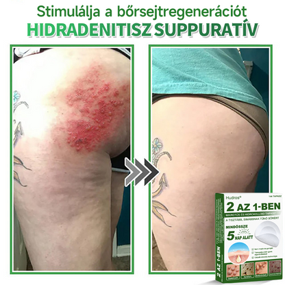 📌 𝐇𝐮𝐝𝐫𝐨𝐬® 𝟐 𝐚𝐳 𝟏-𝐛𝐞𝐧 𝐦𝐢𝐤𝐫𝐨𝐭ű𝐬 𝐡𝐢𝐝𝐫𝐨𝐤𝐨𝐥𝐥𝐨𝐢𝐝 𝐭𝐚𝐩𝐚𝐬𝐳𝐨𝐤 | 𝐊𝐢𝐞𝐦𝐞𝐥𝐤𝐞𝐝ő 𝐚𝐧𝐲𝐚𝐣𝐞𝐠𝐲𝐞𝐤, 𝐩𝐚𝐭𝐭𝐚𝐧á𝐬𝐨𝐤, 𝐥𝐚𝐩𝐨𝐬 𝐬𝐳𝐞𝐦ö𝐥𝐜𝐬ö𝐤 é𝐬 𝐛ő𝐫𝐤𝐢𝐧ö𝐯é𝐬𝐞𝐤 𝐞𝐥𝐭á𝐯𝐨𝐥í𝐭á𝐬á𝐫𝐚 𝐬𝐩𝐞𝐜𝐢𝐚𝐥𝐢𝐳á𝐥𝐯𝐚 | 𝐋á𝐭𝐡𝐚𝐭𝐚𝐭𝐥𝐚𝐧, 𝐜𝐬𝐢𝐥𝐥𝐚𝐠 𝐚𝐥𝐚𝐤ú 𝐩𝐚𝐭𝐭𝐚𝐧á𝐬𝐭𝐚𝐩𝐚𝐬𝐳𝐨𝐤 (𝐚𝐫𝐜𝐫𝐚 é𝐬 𝐭𝐞𝐬𝐭𝐫𝐞) | 𝟏𝟒𝟒 𝐝𝐚𝐫𝐚𝐛𝐨𝐬 𝐜𝐬𝐨𝐦𝐚𝐠🌱