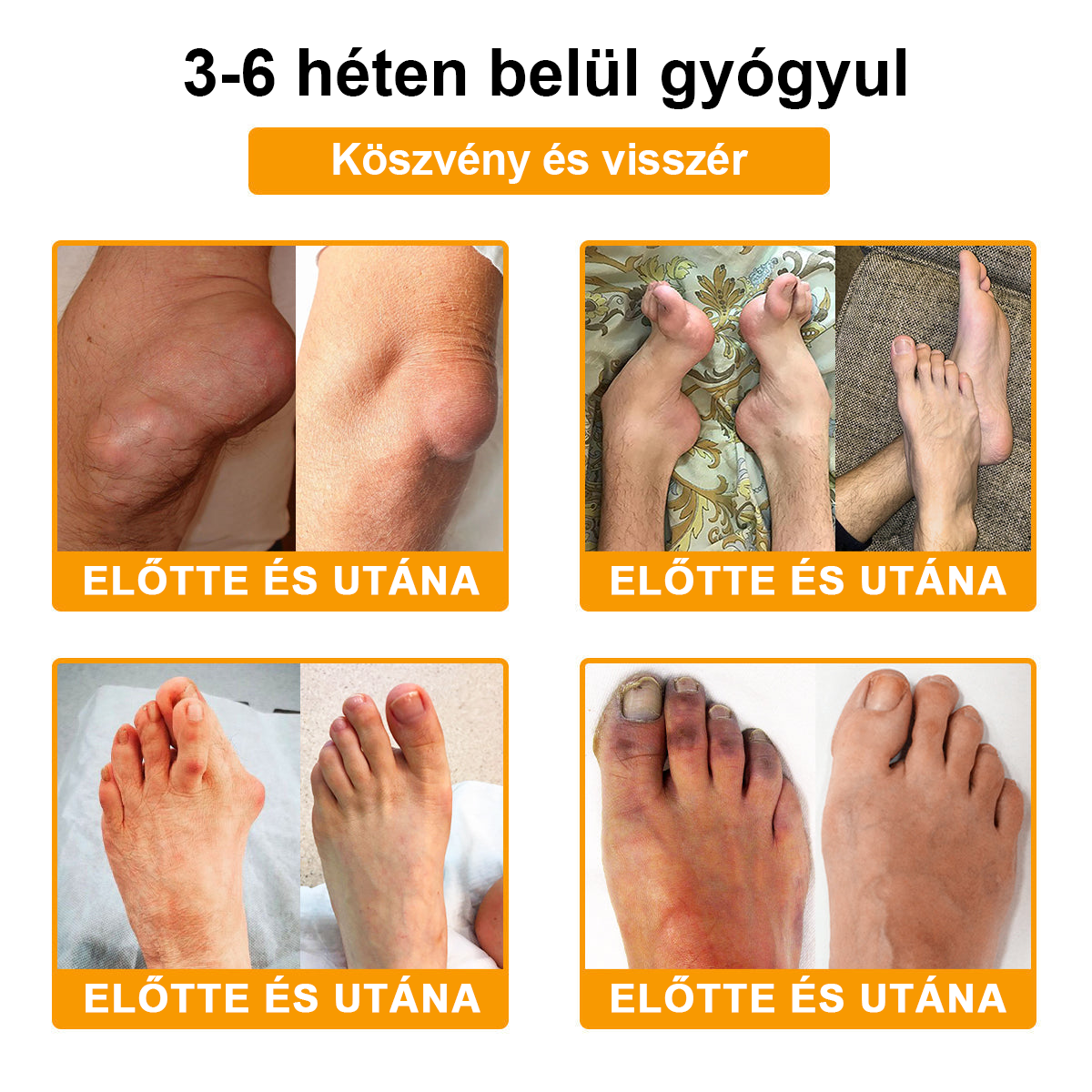 ✅TLOPA® Fájdalomcsillapító, 😊csontregeneráló krém botulinum-toxinnal és méhméreggel 🐝